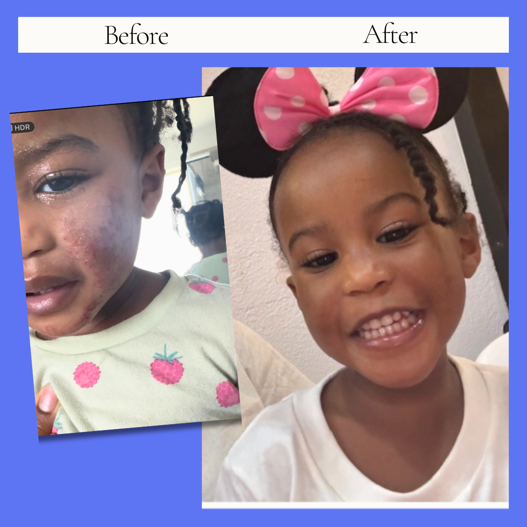 Updated before-and-after images provided for Averie’s eczema story